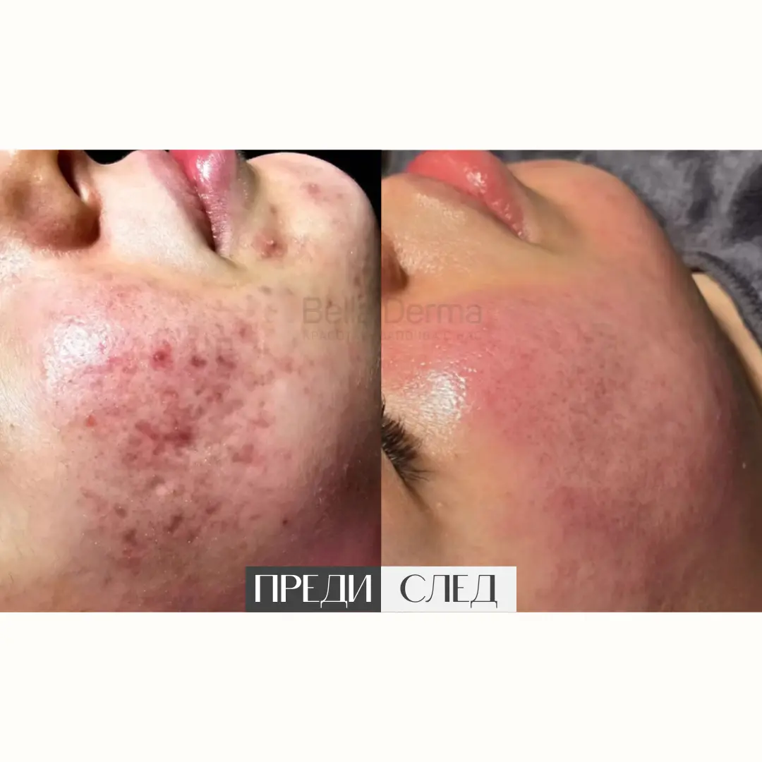 Преди и след процедура в Bella Derma 1
