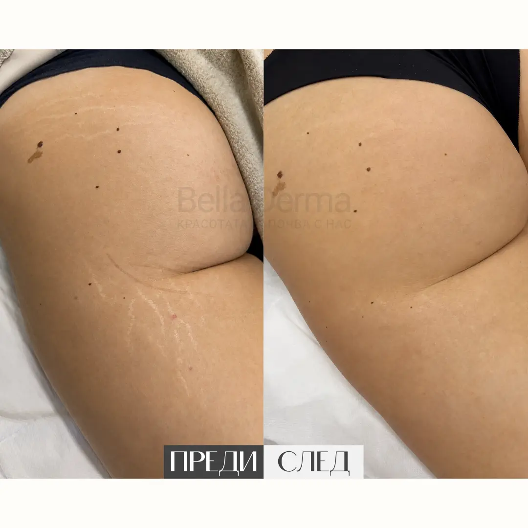Преди и след процедура в Bella Derma 10
