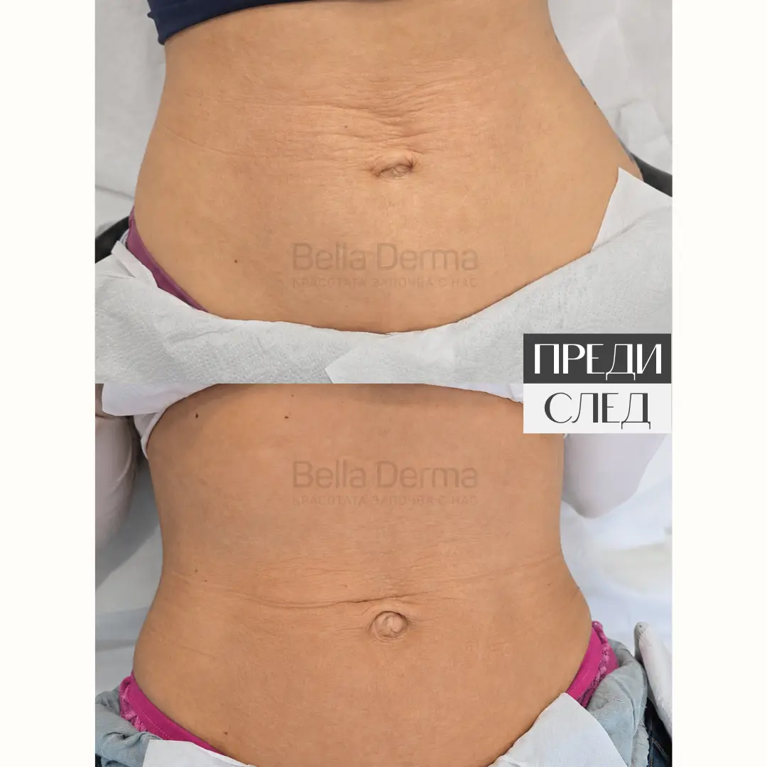 Преди и след процедура в Bella Derma 11
