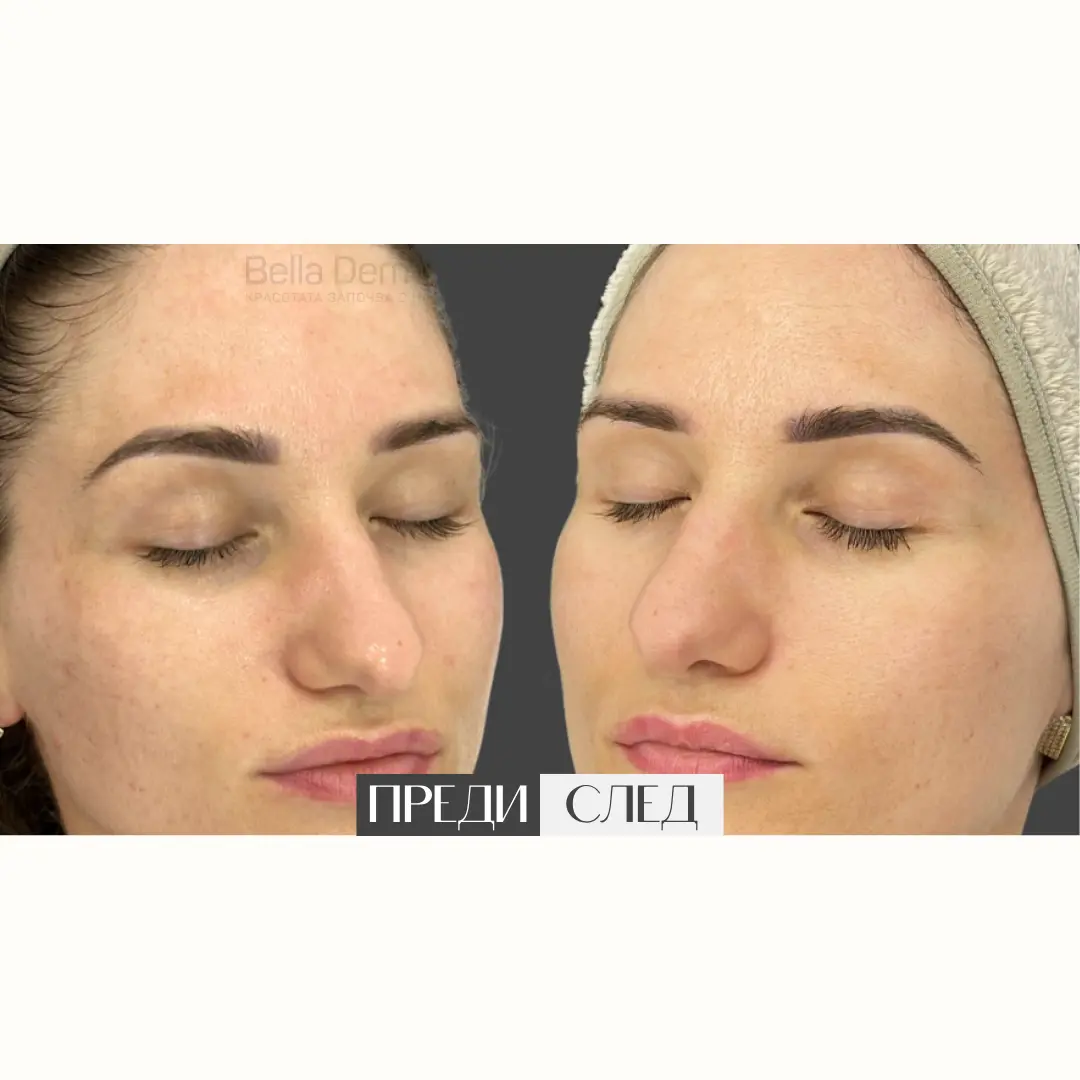 Преди и след процедура в Bella Derma 12