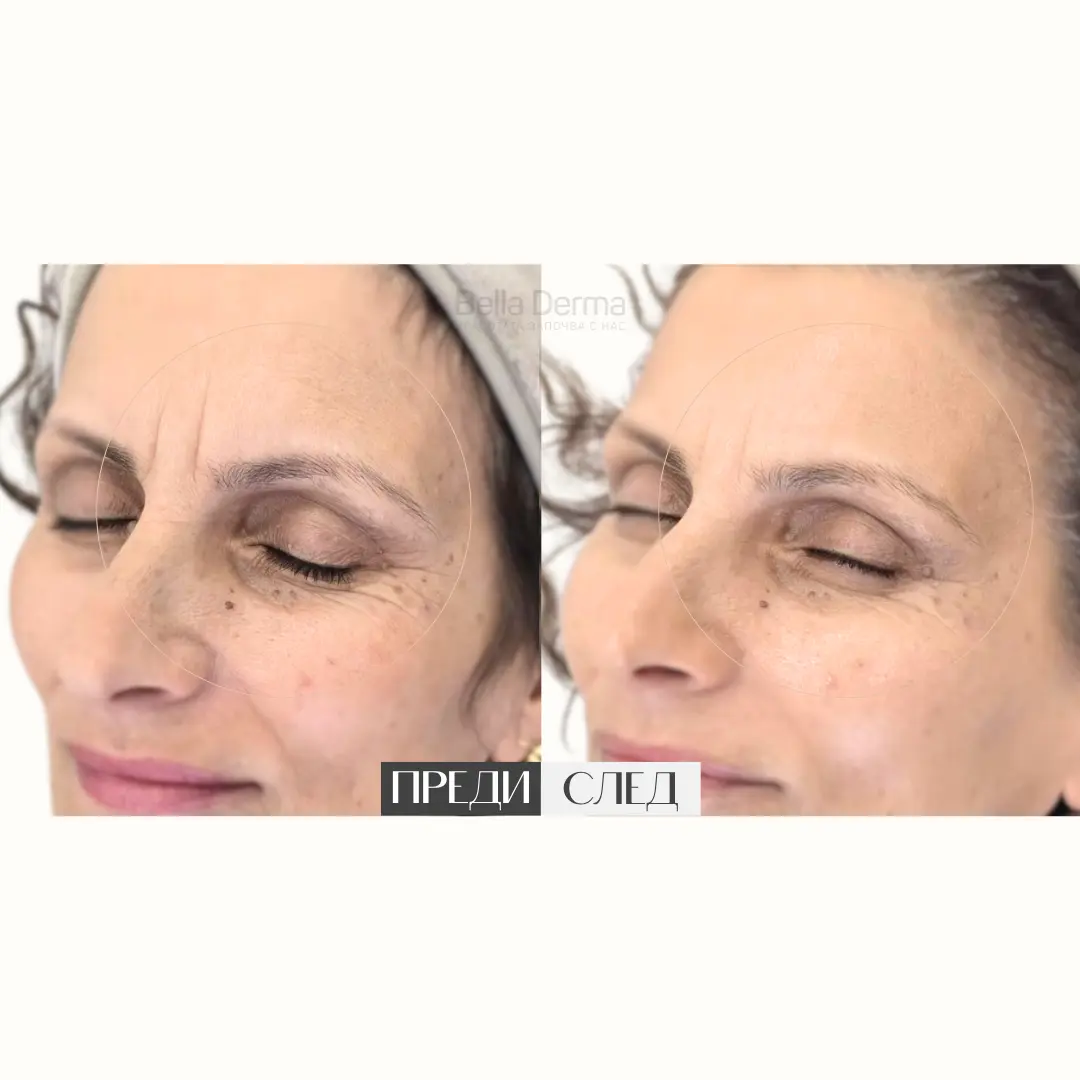 Преди и след процедура в Bella Derma 13