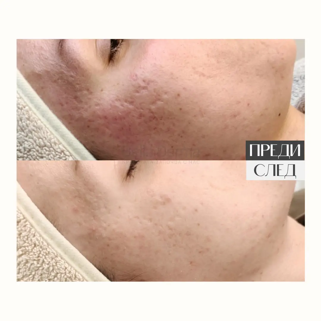 Преди и след процедура в Bella Derma 16