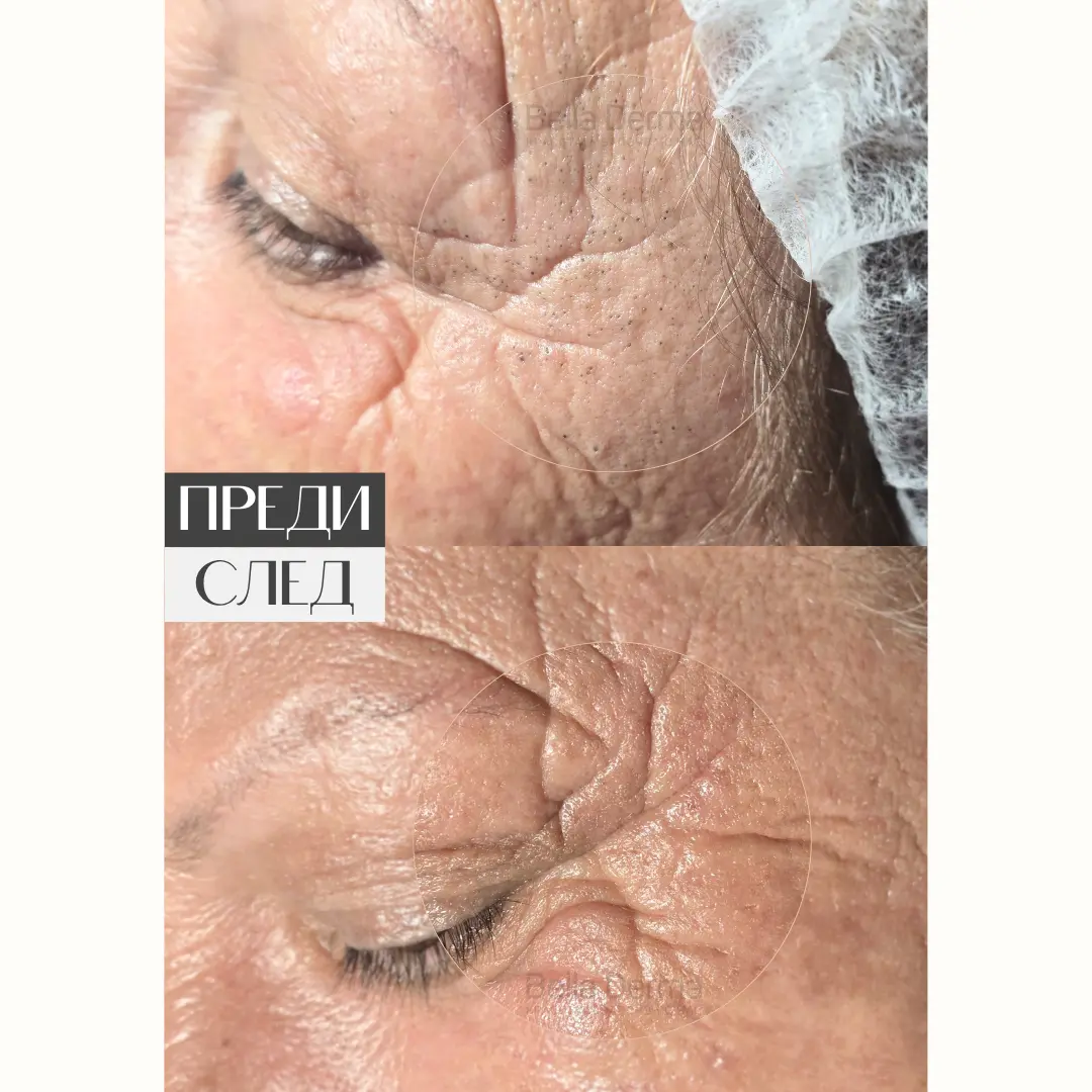 Преди и след процедура в Bella Derma 17
