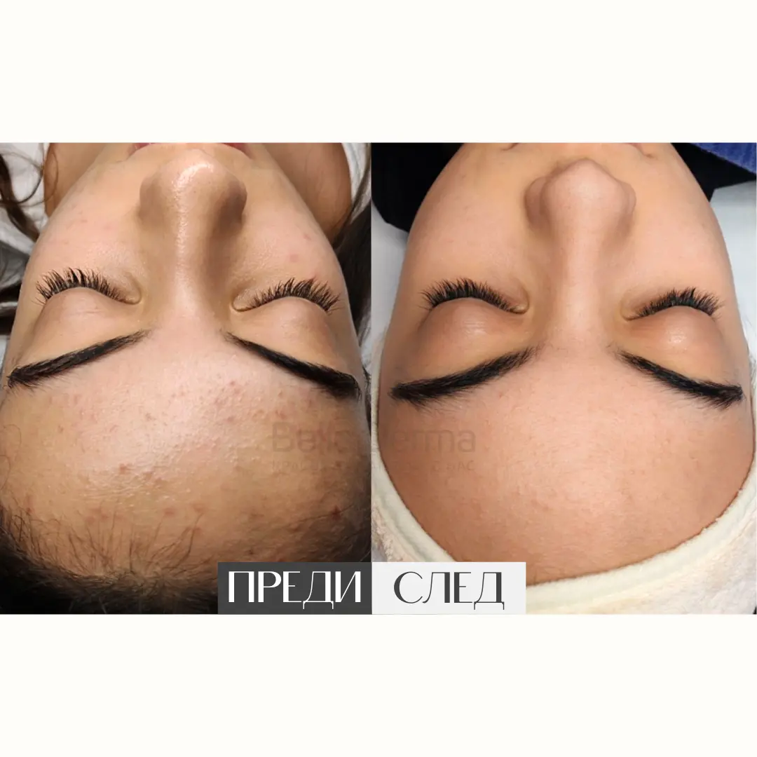 Преди и след процедура в Bella Derma 2