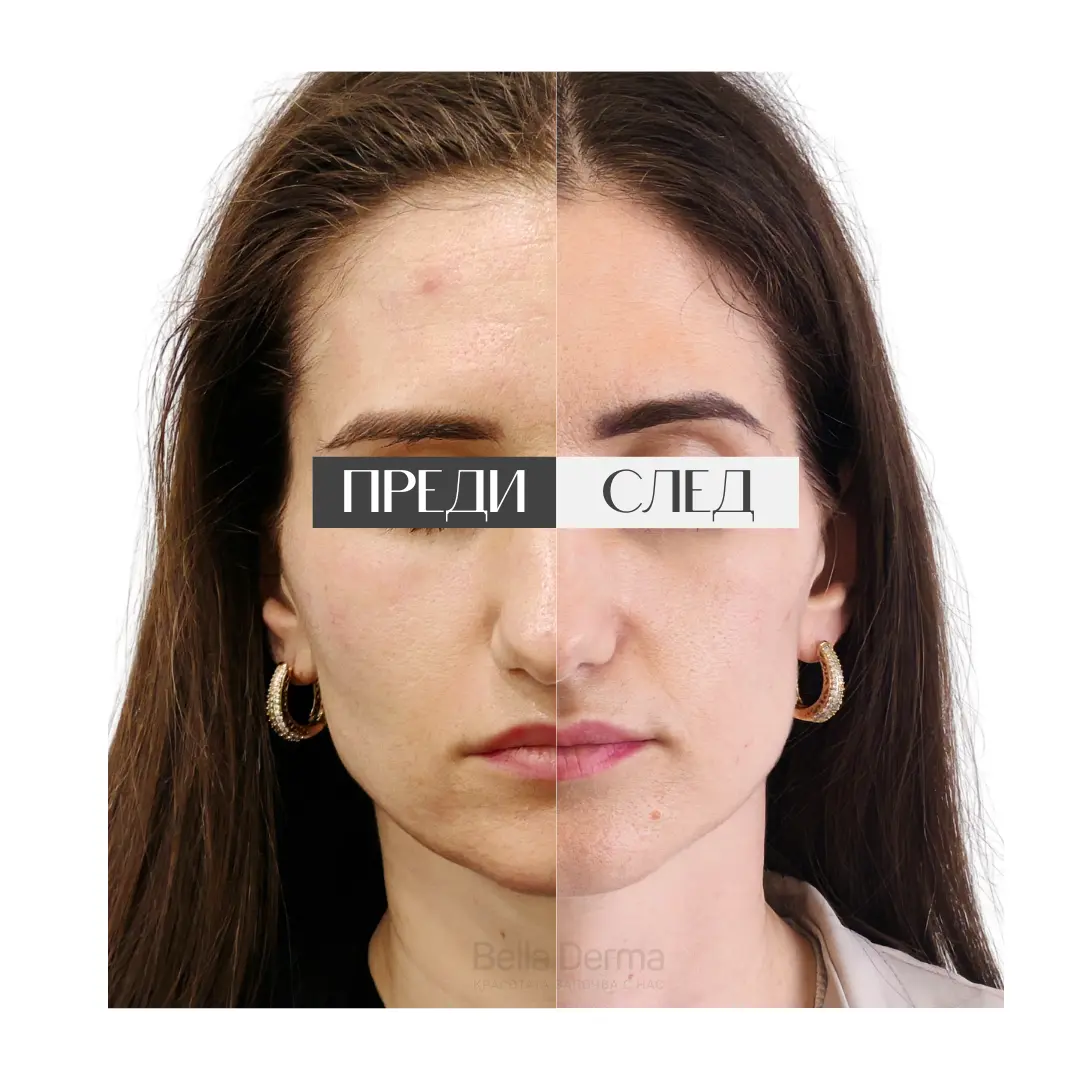 Преди и след процедура в Bella Derma 4