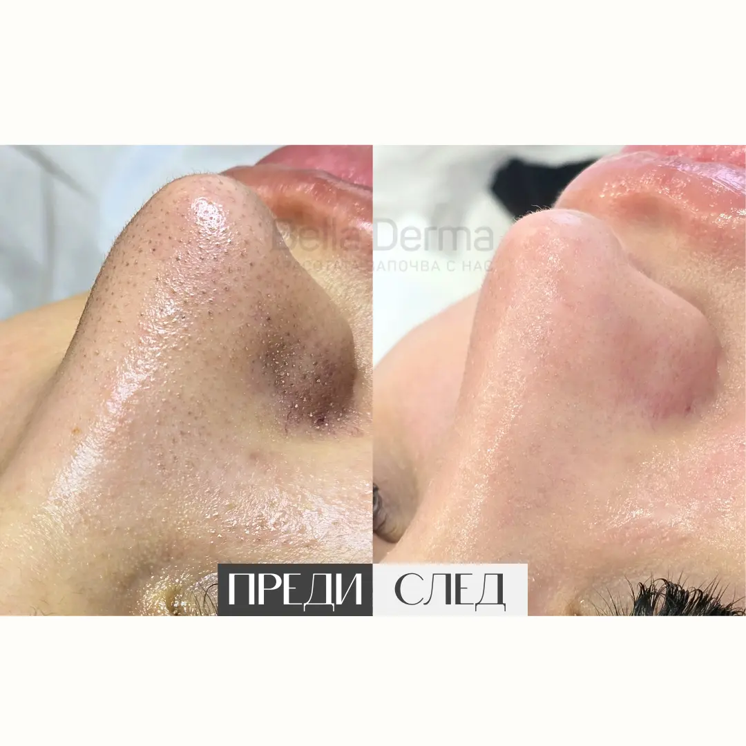 Преди и след процедура в Bella Derma 5