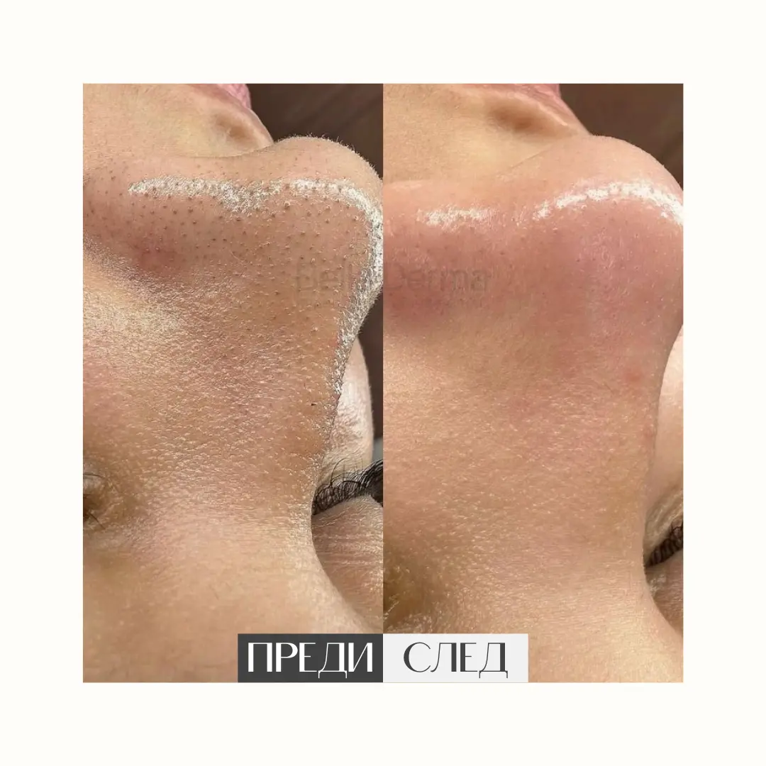 Преди и след процедура в Bella Derma 6