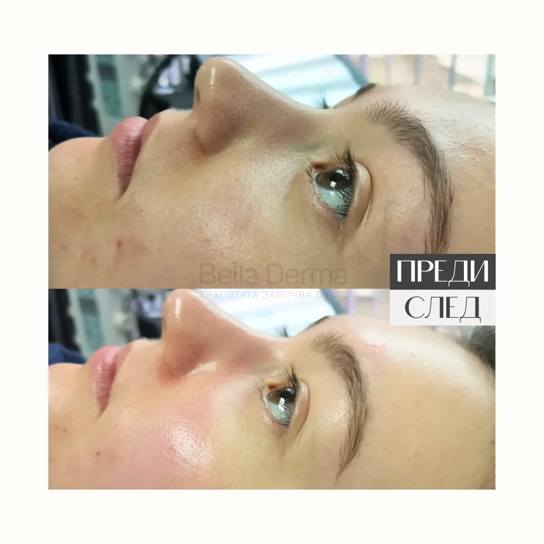 Преди и след процедура в Bella Derma 7