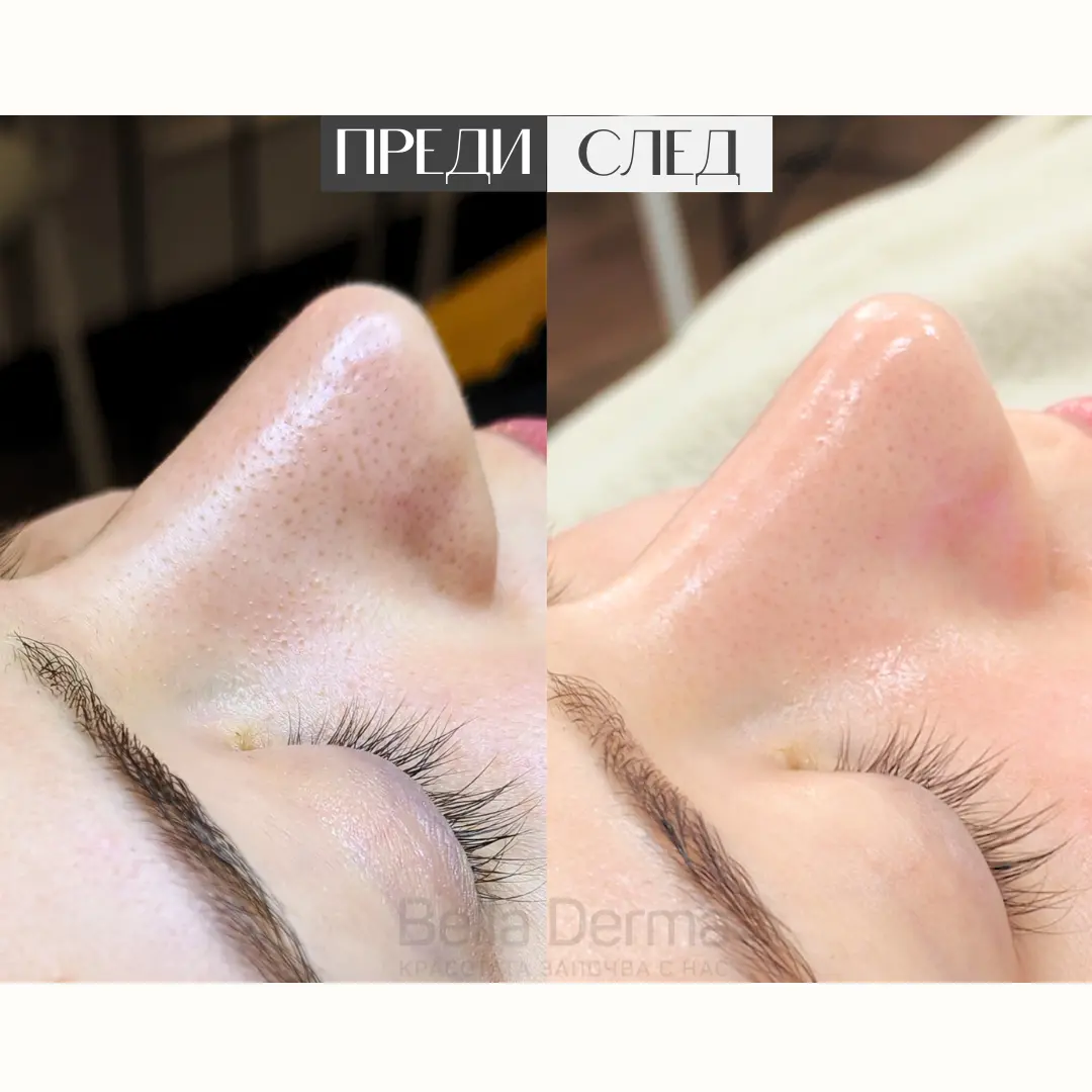 Преди и след процедура в Bella Derma 8