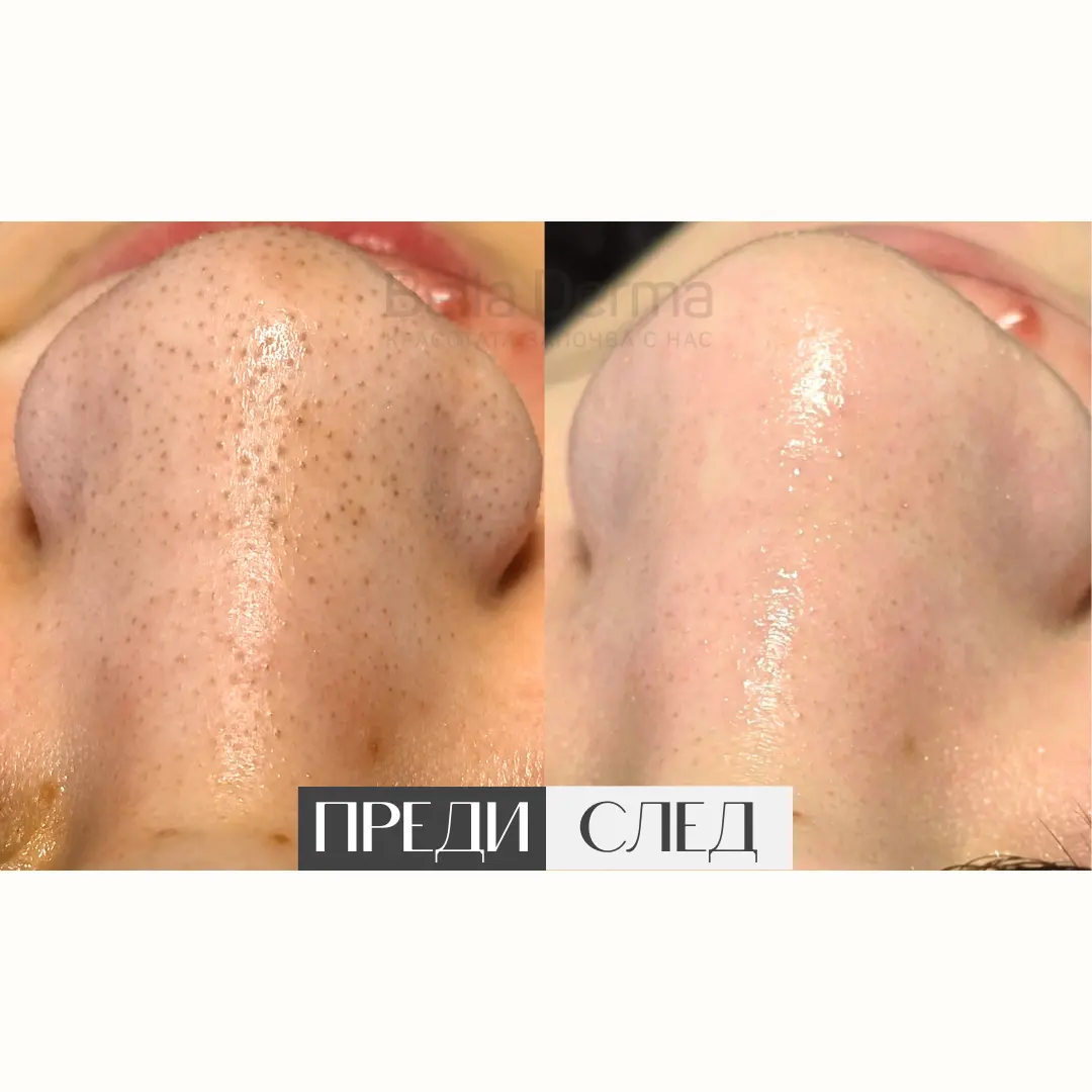 Преди и след процедура в Bella Derma 9