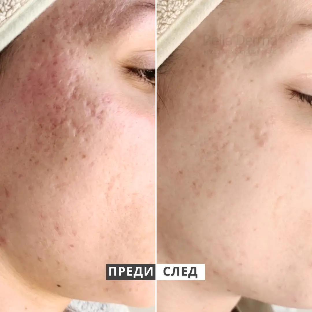 Преди и след — комбинирана кожа, 3 процедури