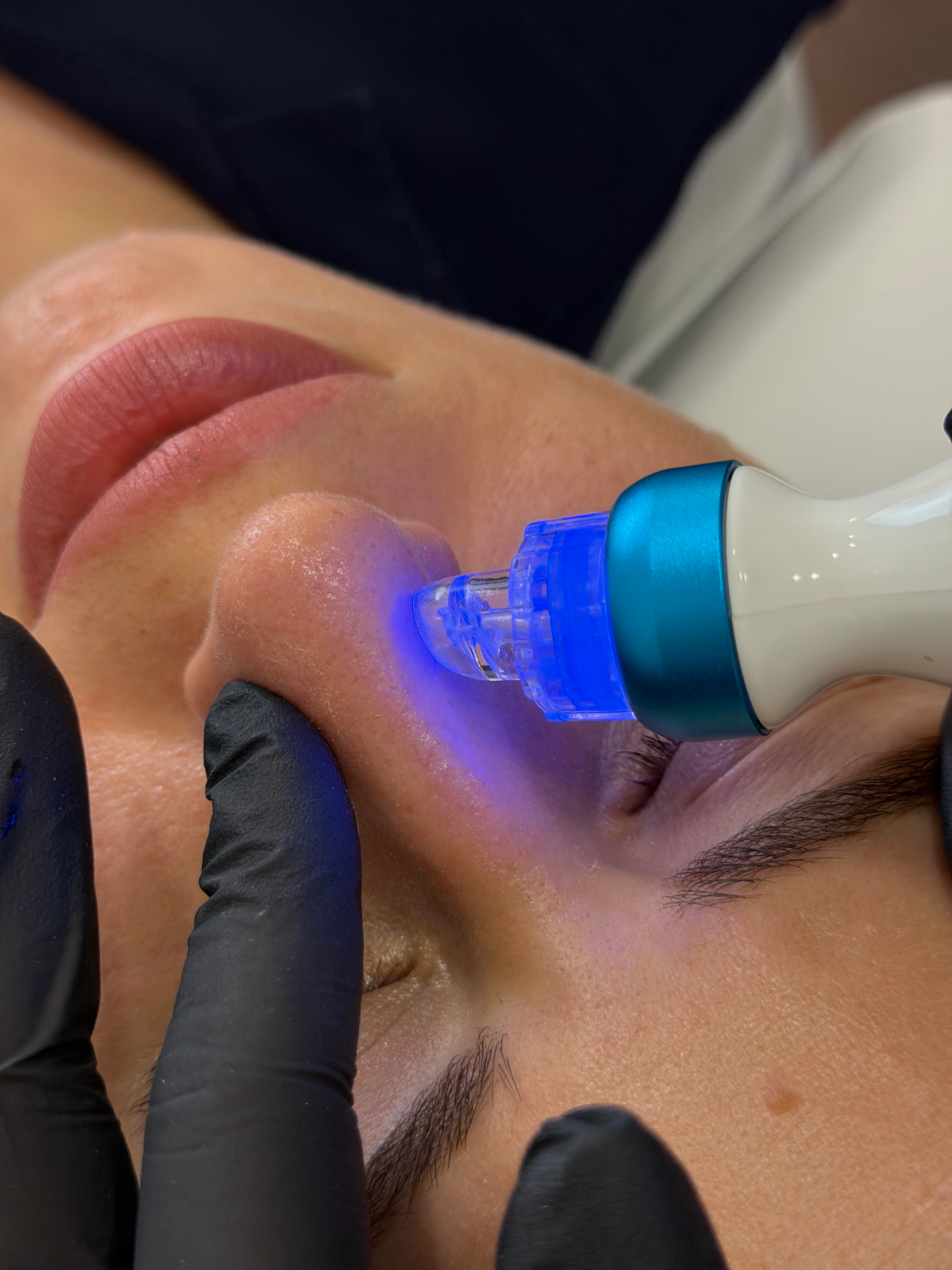 Hydra Aqua Peel апаратно почистване на лице в Bella Derma