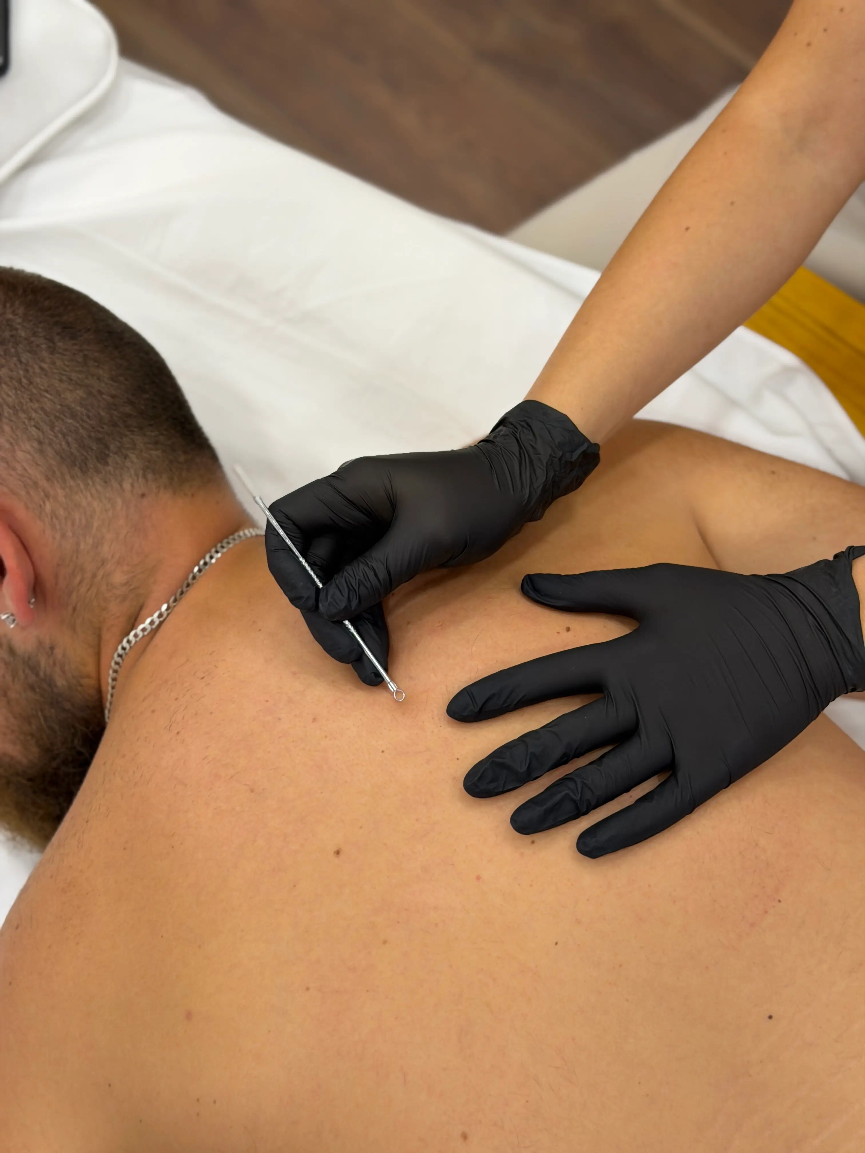 Комбинирано дълбоко почистване на гръб във Варна – Bella Derma