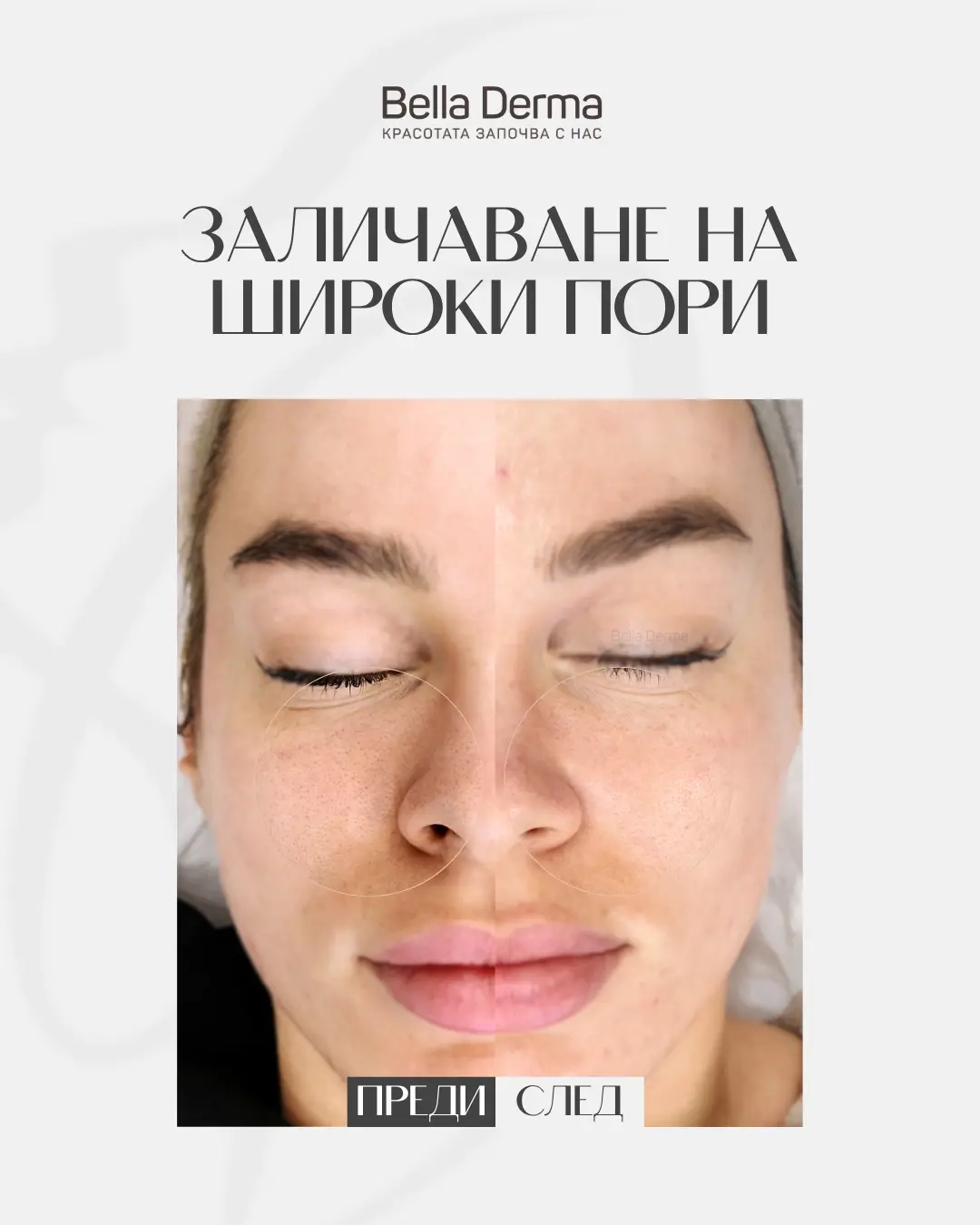 Sylfirm X – заличаване на широки пори (преди и след)