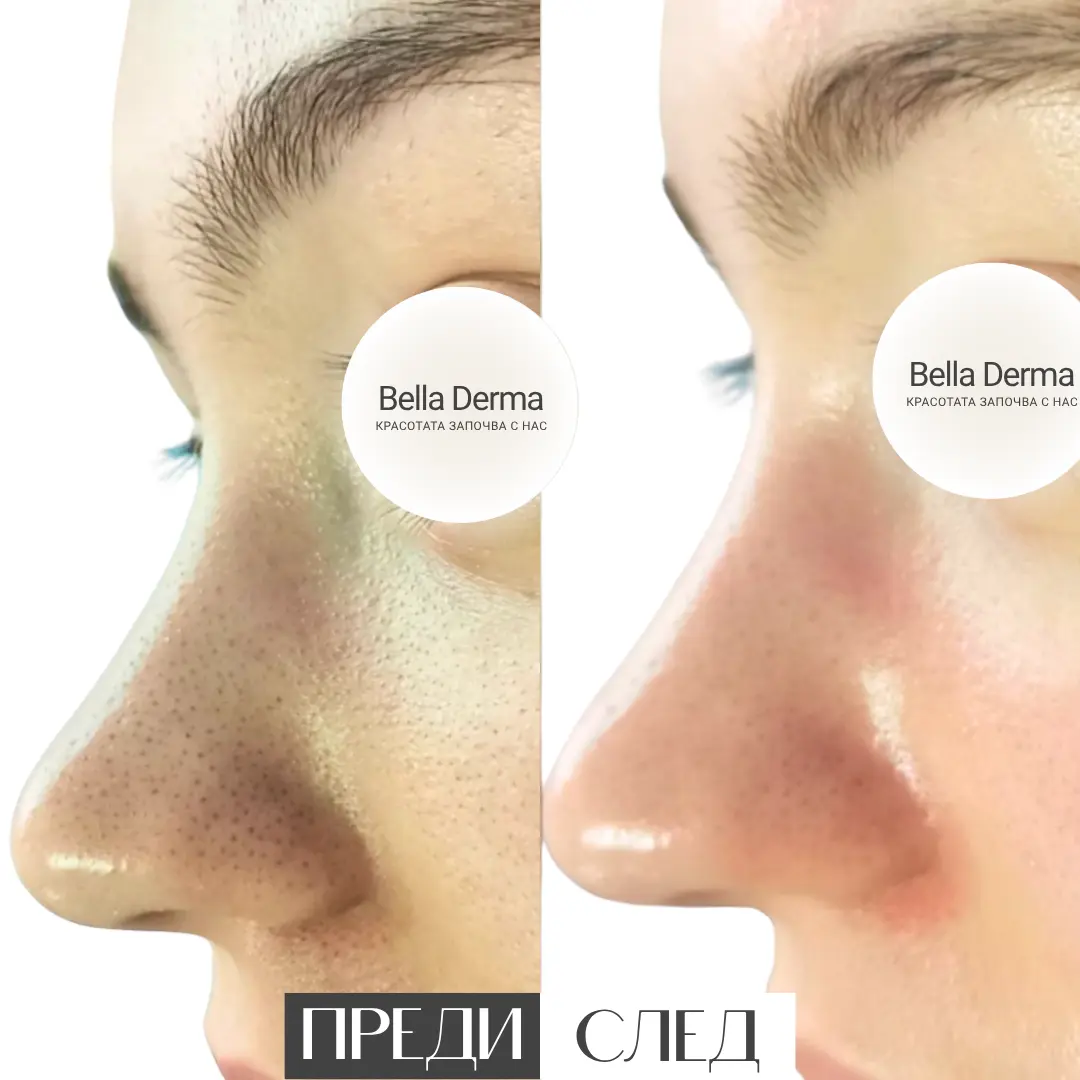 Реален резултат преди и след Hydra Aqua Peel