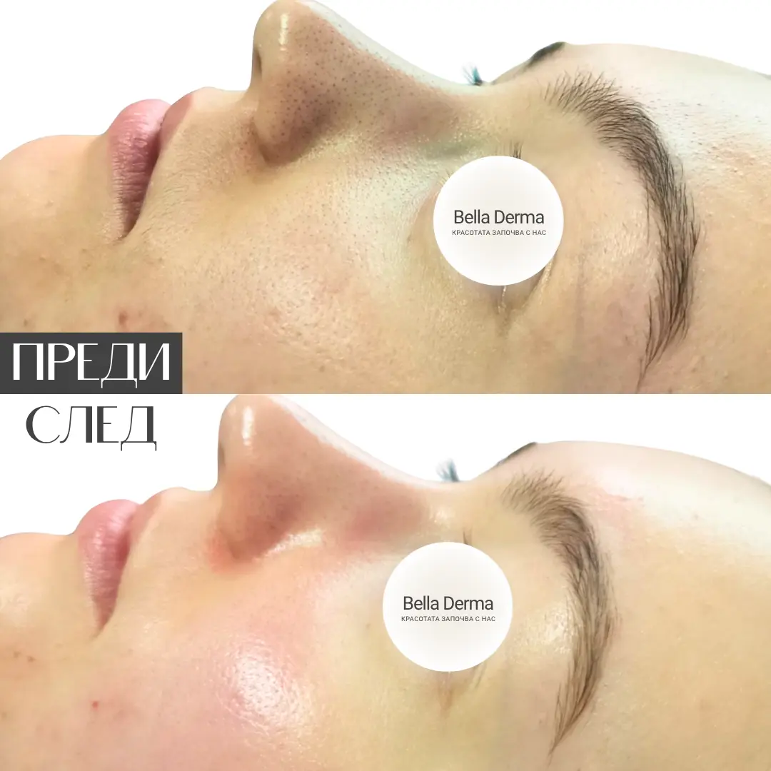 Реален резултат преди и след Hydra Aqua Peel