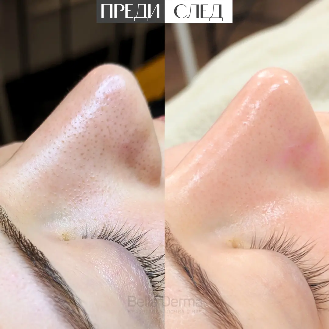 Реален резултат преди и след Hydra Aqua Peel