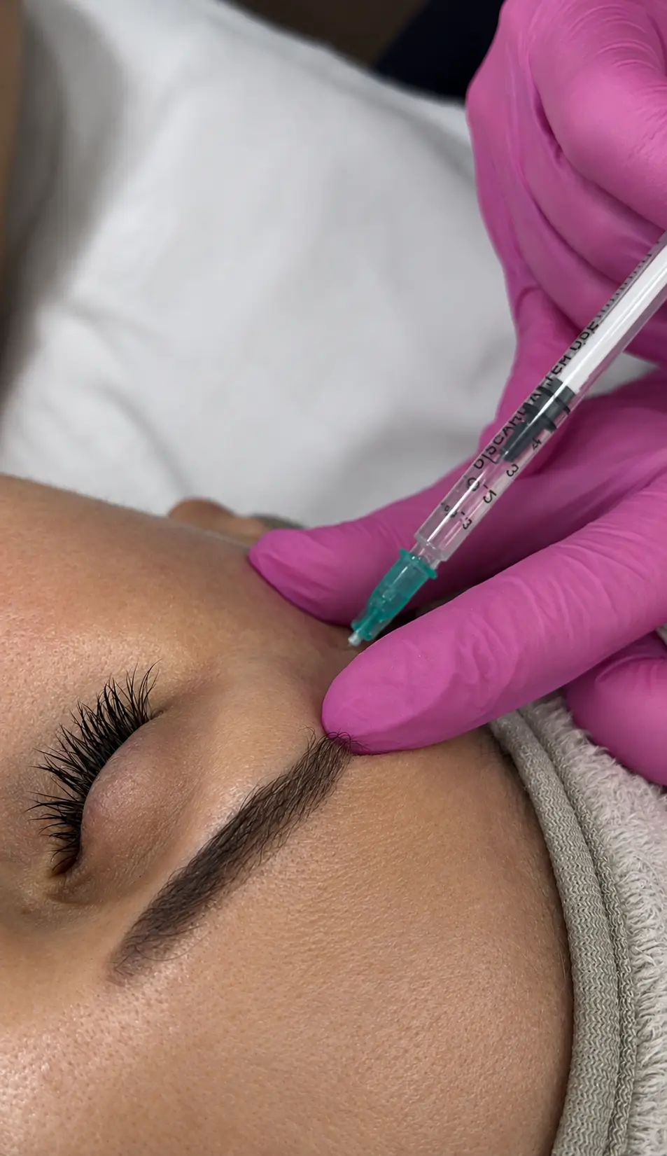 Toskani мезотерапия в околоочната зона в Bella Derma